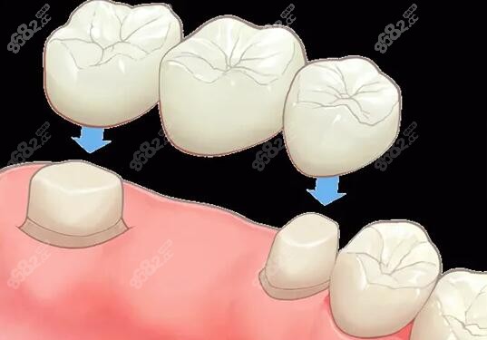 搭桥牙齿的利与弊m.8682.cc