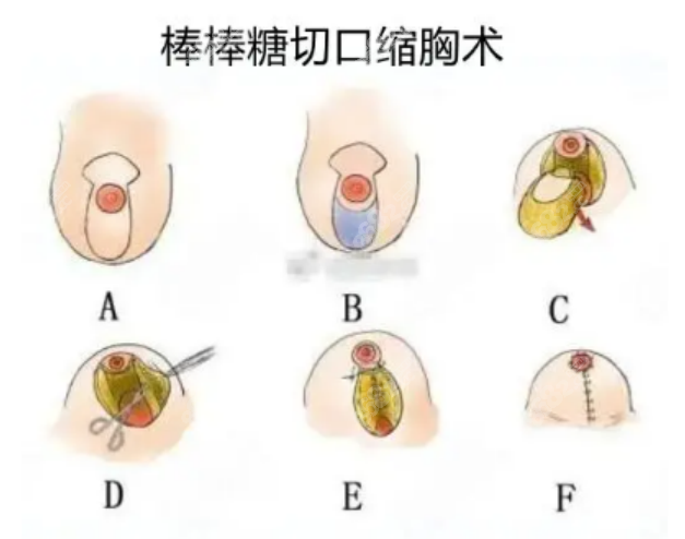 美莱栗勇缩胸多少钱？