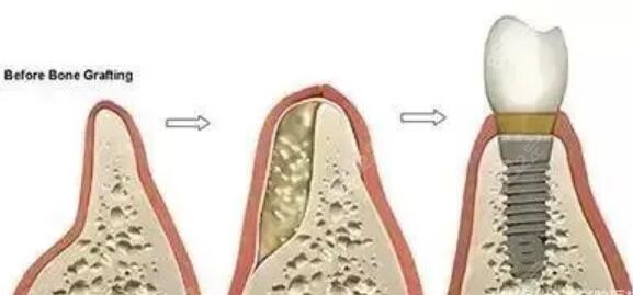 做种植牙为什么需要植骨