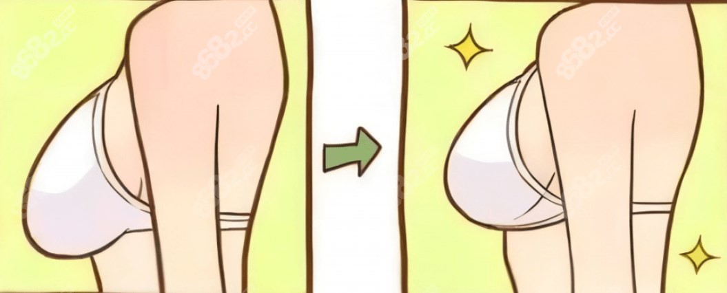 乳房花苞提升术前后对比图片