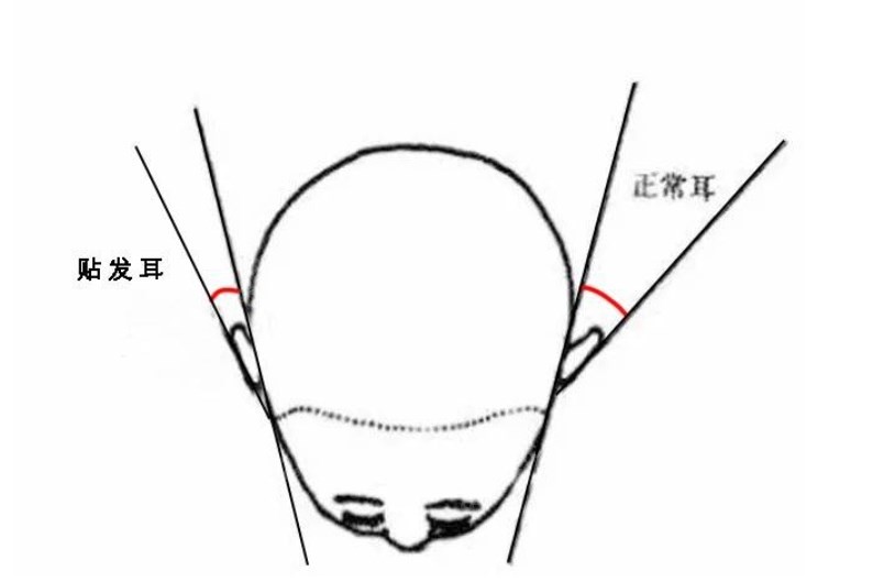 余文林医生矫正贴发耳技术真的好