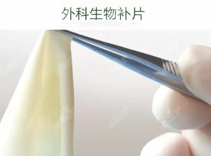 生物补片隆胸能让乳房手感更柔软m.8682.cc