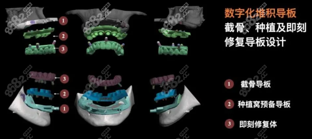 维乐口腔数字化导板种植技术