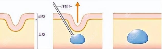 菲林普利果冻针多少钱一支