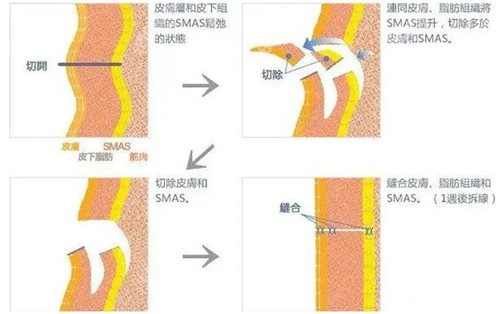 杨大平医生做小切口MACS提升手术价格4万起