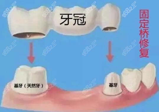 搭桥牙齿能用多久