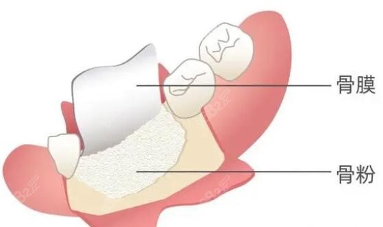 什么是种植牙植骨m.8682.cc