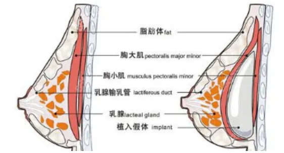 15分钟丰胸