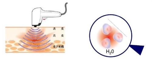 热拉提将热作用于皮肤组织