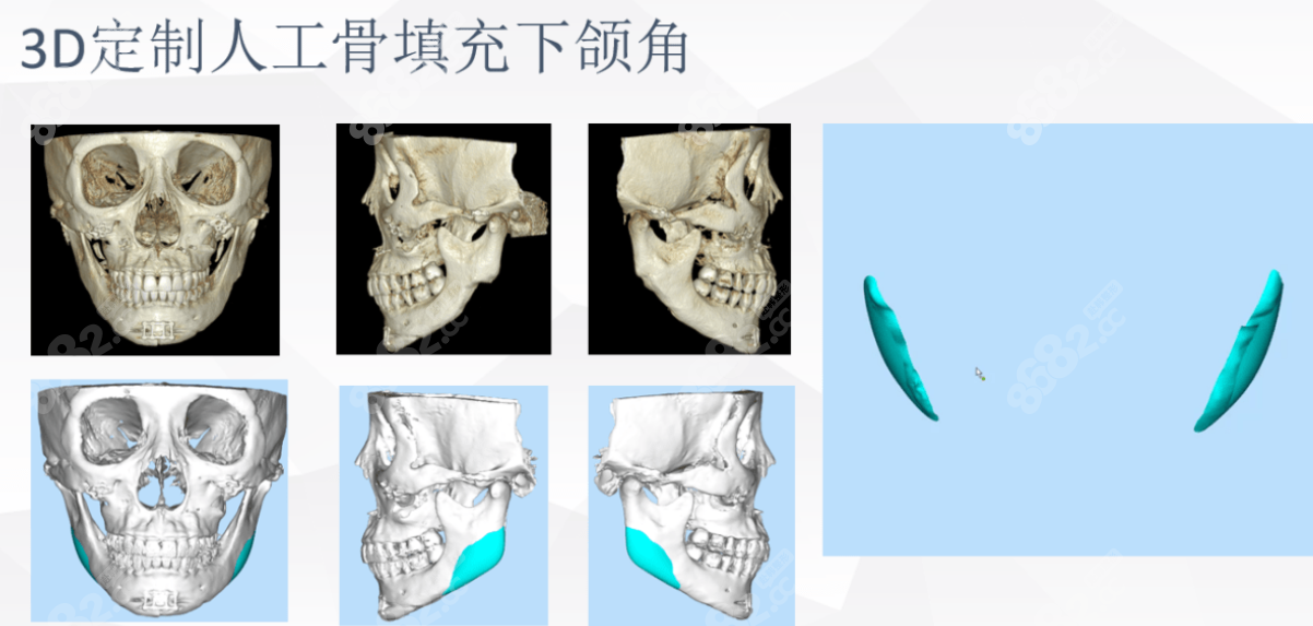 3Dpeek下颌角修复