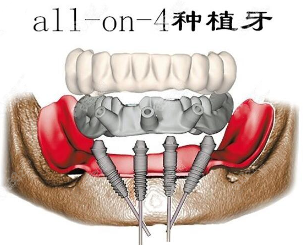 all-on-4全口种植牙