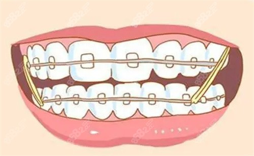 牙齿矫正橡皮圈固定演示图