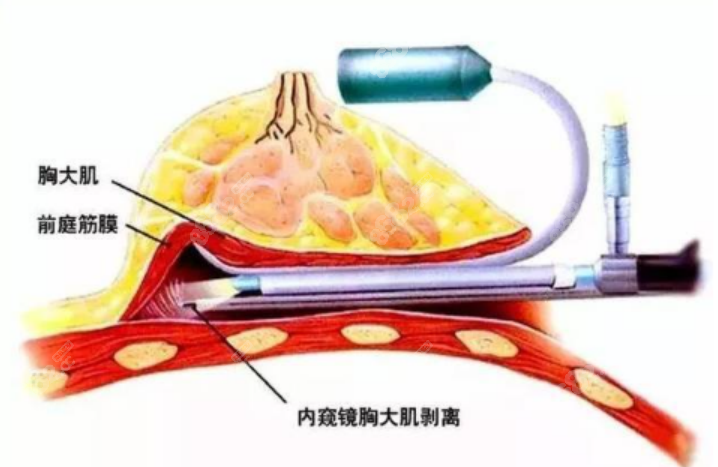 15分钟丰胸真的没有其他并发症吗？