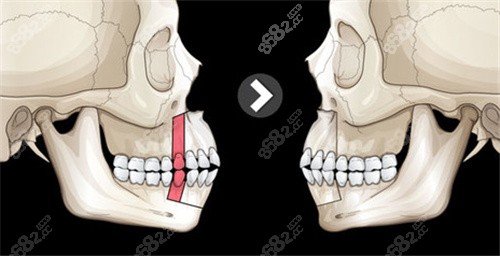 正颌手术动画对比照