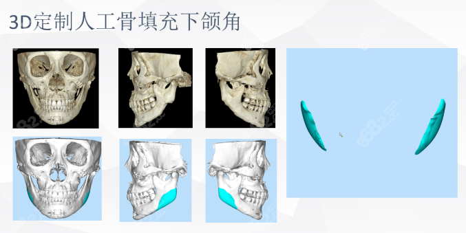 上海时光peek下颌角修复手术图示