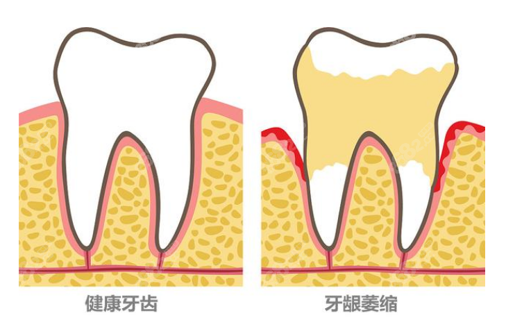 恢复牙龈萎缩的方法