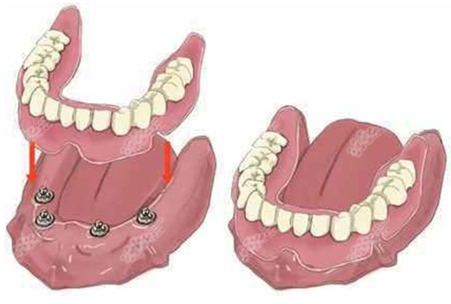 半固定全口种植牙过程图8682.cc