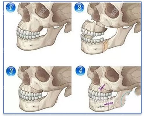 正颌手术方式演示图