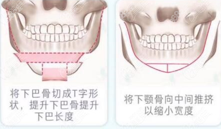 下巴后缩整形示意图