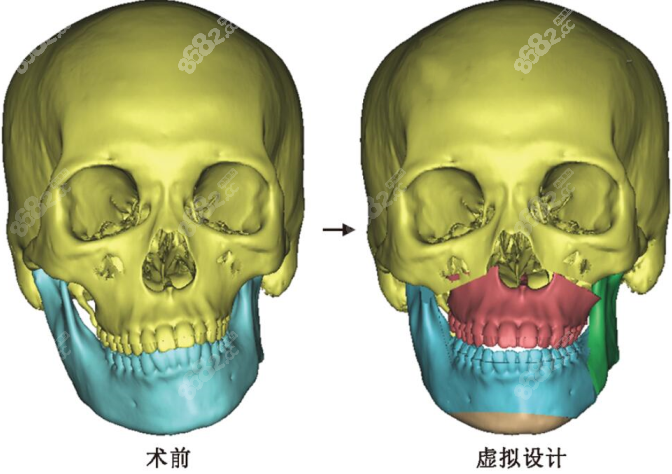 <!--<i data=20240705-sp></i>-->正颌手术图示