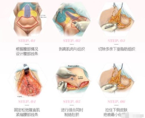 腹壁整形手术示意图