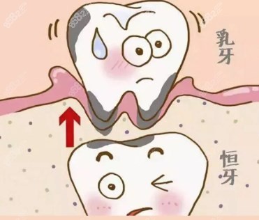 恒压萌出乳牙不脱落