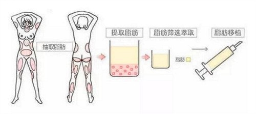 脂肪移植填充步骤