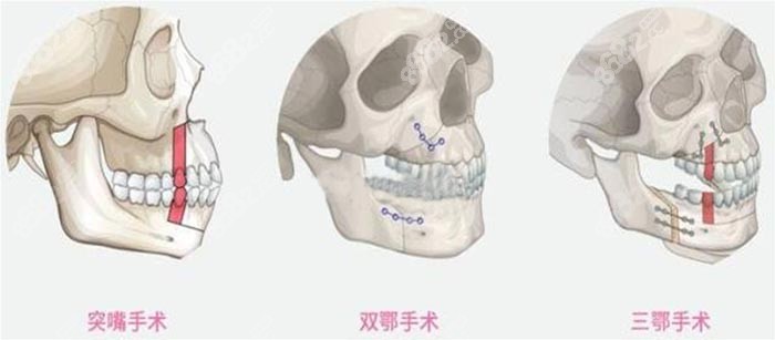 国内做正颌手术的原理图