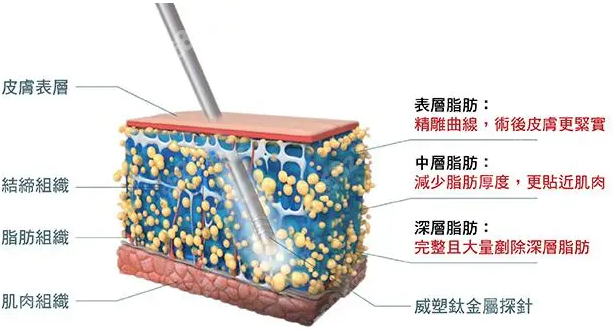 威塑吸脂仪器优缺点解析