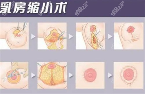 栗勇缩胸手术价格表