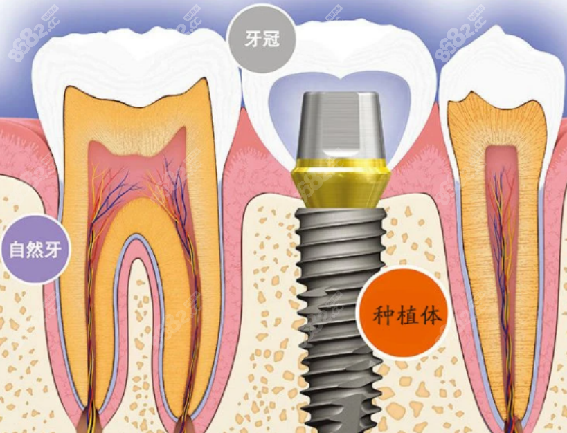 上海鼎植口腔医院种植牙