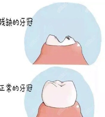 残根牙齿