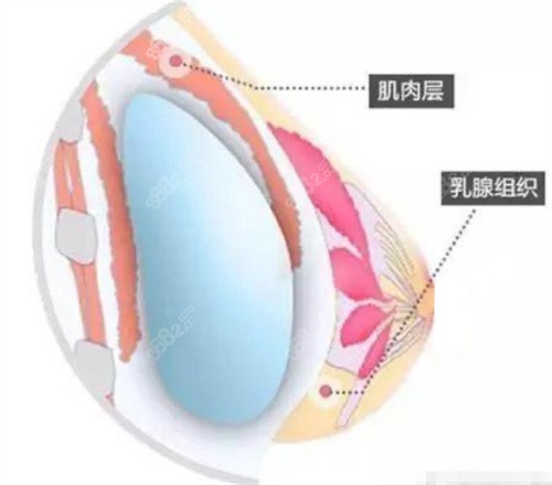 <!--<i data=20240705-sp></i>-->双平面隆胸