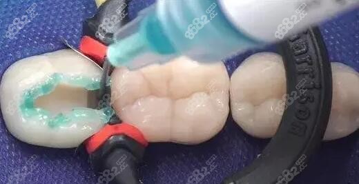 科尔树脂补牙材料m.8682.cc
