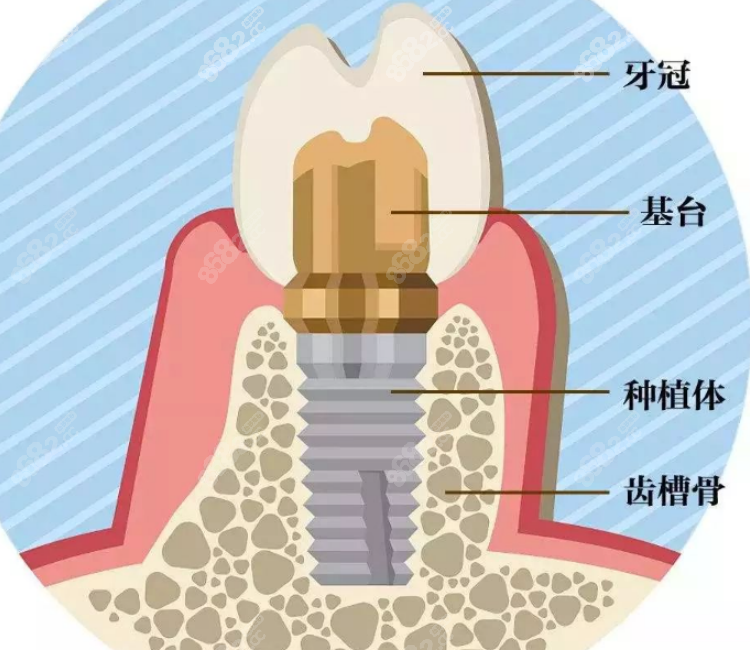 上海鼎植口腔医院种植牙集采后多少钱