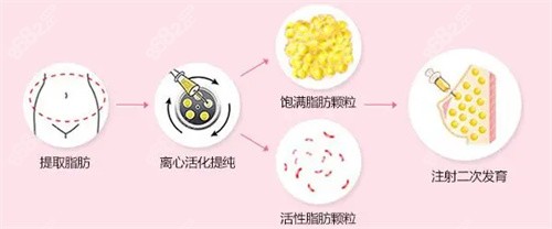 腰腹部脂肪需提纯后注射