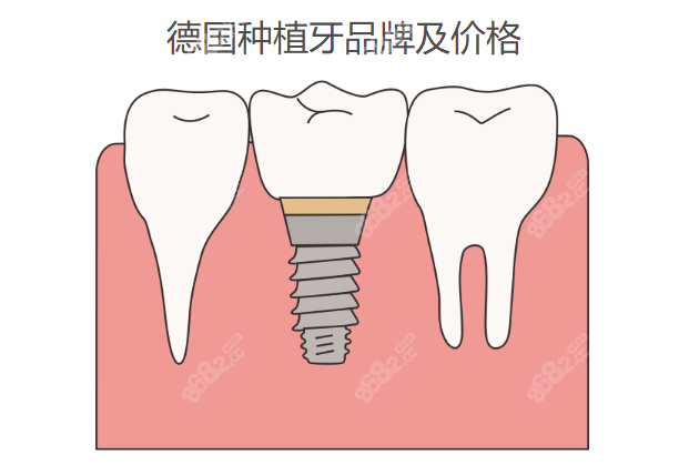 什么是卡瓦牙德国种植牙品牌及价格,icx8000／贝格9000／卡瓦9000-上海聚慕医疗器械有限公司