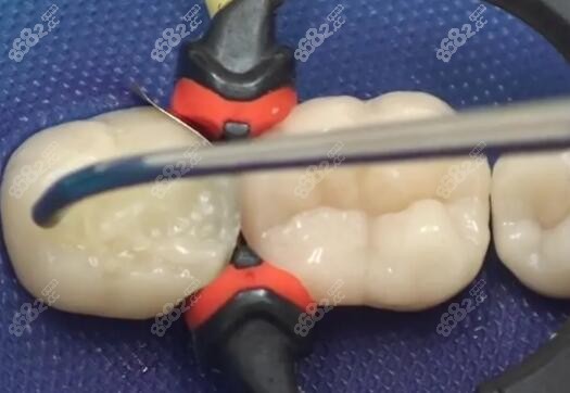 3M树脂补牙材料