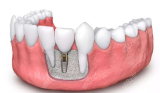 钛植口腔医院双井总院怎么样是数字种植吗