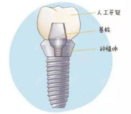 钛植口腔医院双井总院种植牙
