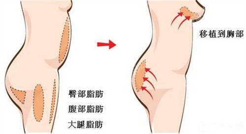 自体脂肪丰胸可改善肥胖