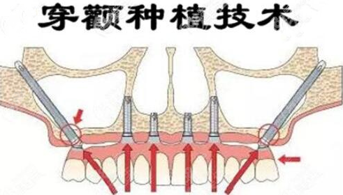穿颧穿翼种植技术