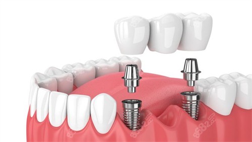 多颗种植牙图示