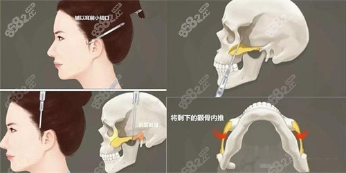 颧骨整形示意图