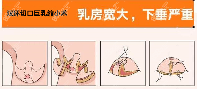 双环切口缩胸术疗效明显8682.cc