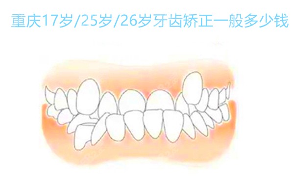 重庆17岁、25岁、26岁牙齿矫正一般多少钱