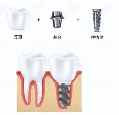 种植牙结构