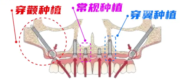 穿颧穿翼种植手术过程图示8682.cc