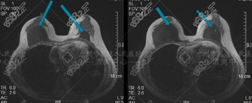 胸部奧美定取出