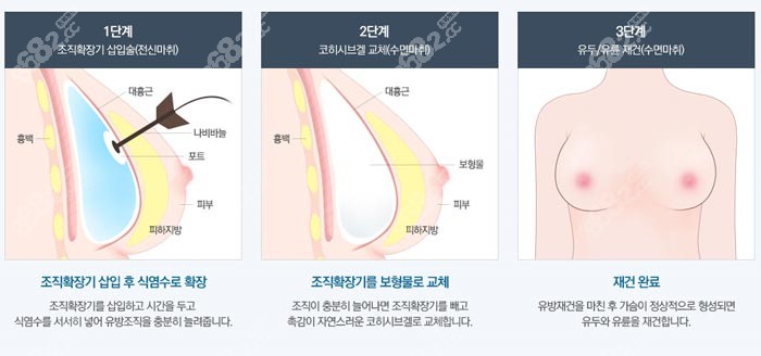 韩国md整形隆胸技术原理图